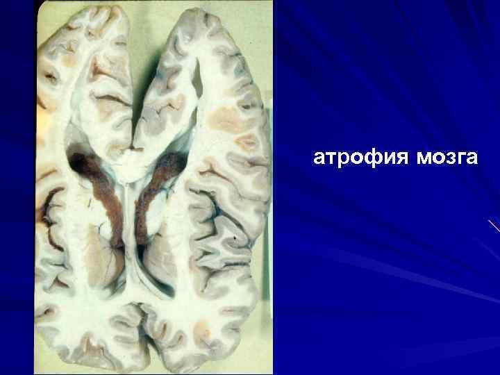 атрофия мозга 