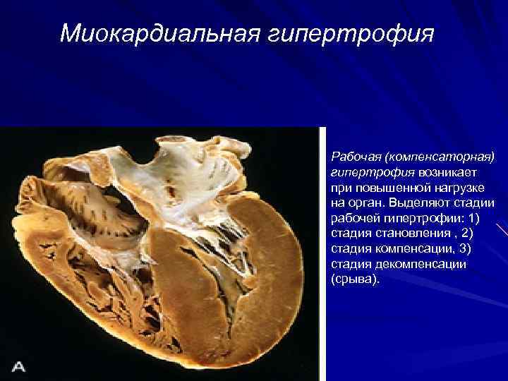 Рабочая компенсаторная гипертрофия презентация