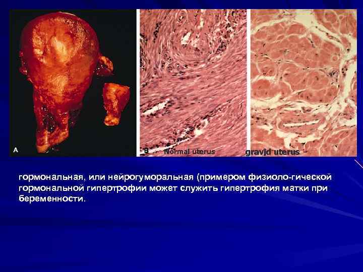 Normal uterus gravid uterus гормональная, или нейрогуморальная (примером физиоло гической гормональной гипертрофии может служить