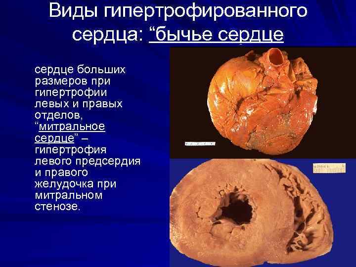 Виды гипертрофированного сердца: “бычье сердце больших размеров при гипертрофии левых и правых отделов, “митральное