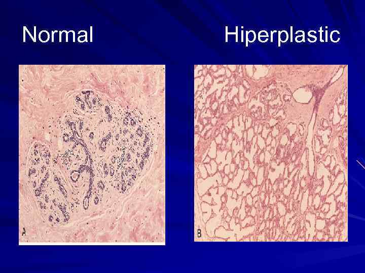 Normal Hiperplastic 
