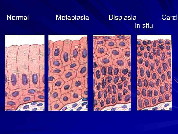 Normal Metaplasia Displasia Carcin in situ 