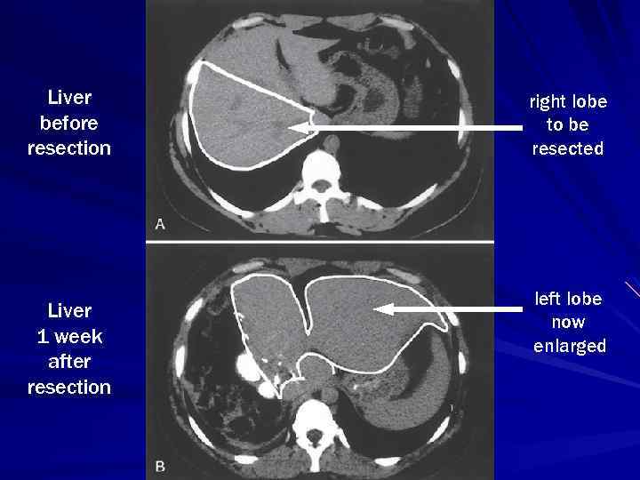 Liver before resection Liver 1 week after resection right lobe to be resected left