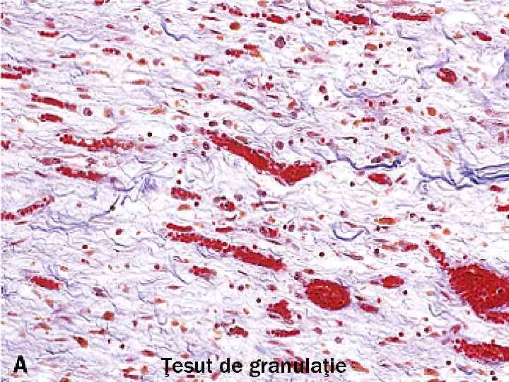 Ţesut de granulaţie 
