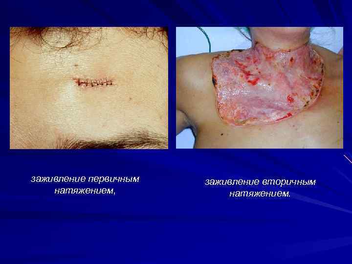 заживление первичным натяжением, заживление вторичным натяжением. 
