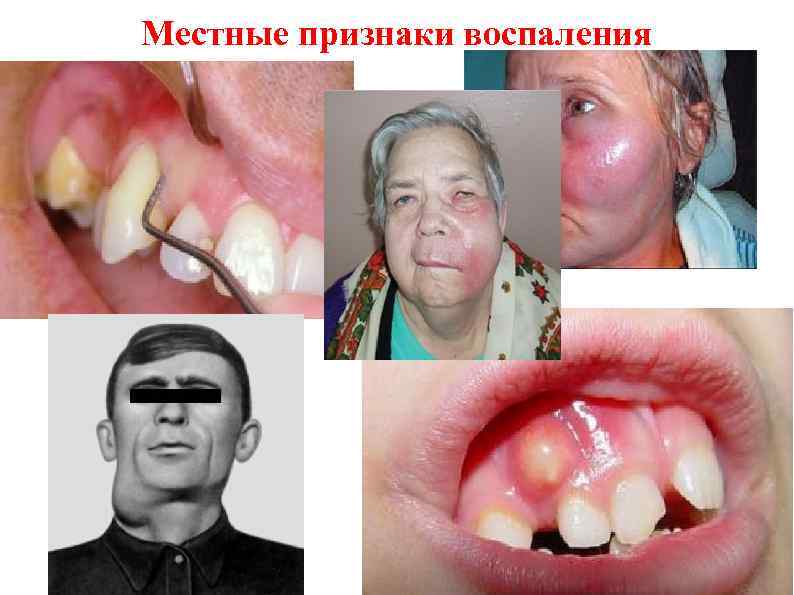 Местные признаки воспаления местны 
