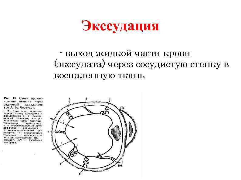 Экссудация - выход жидкой части крови (экссудата) через сосудистую стенку в воспаленную ткань. 