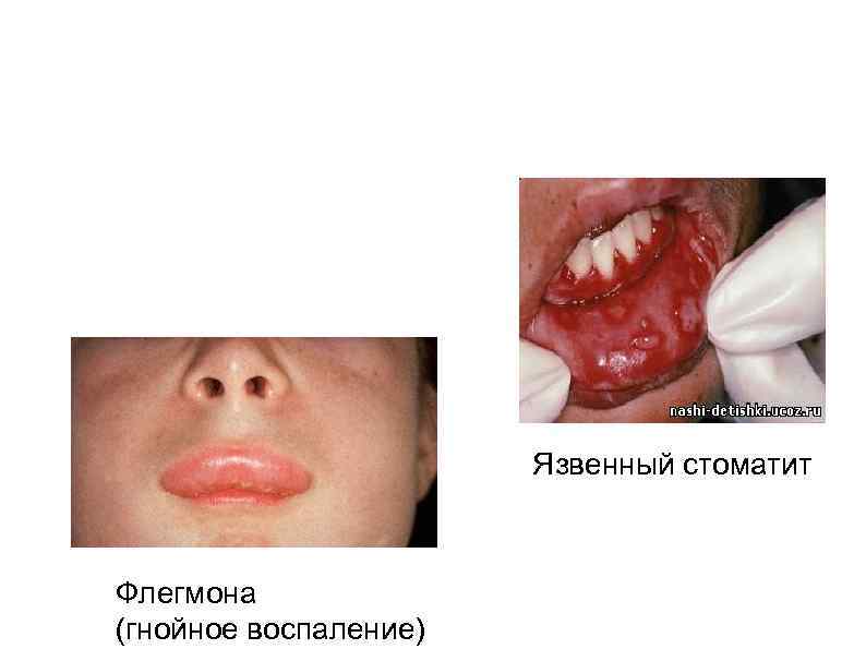 Язвенный стоматит Флегмона (гнойное воспаление) 