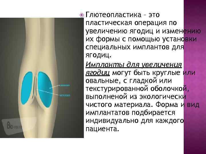  Глютеопластика – это пластическая операция по увеличению ягодиц и изменению их формы с