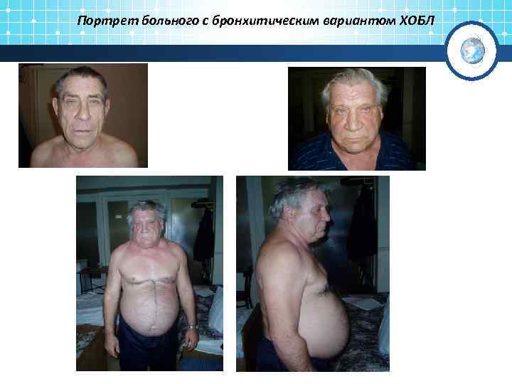 Портрет больного с бронхитическим вариантом ХОБЛ 