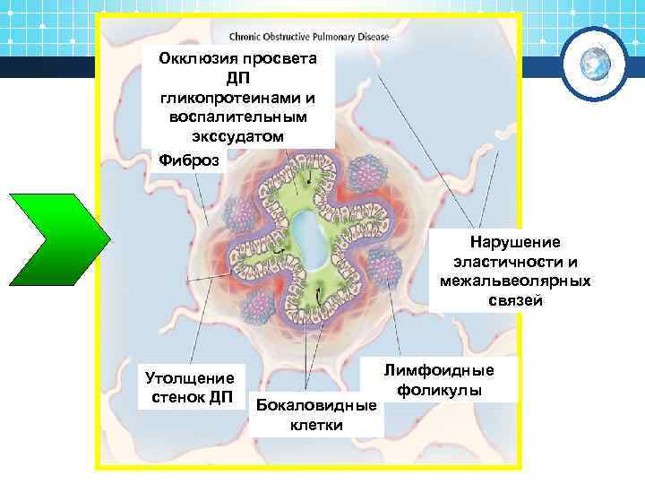 Окклюзия просвета ДП гликопротеинами и воспалительным экссудатом Фиброз Нарушение эластичности и межальвеолярных связей Утолщение