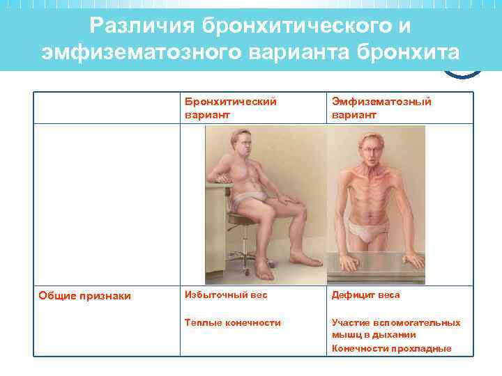 Различия бронхитического и эмфизематозного варианта бронхита Бронхитический вариант Общие признаки Эмфизематозный вариант Избыточный вес