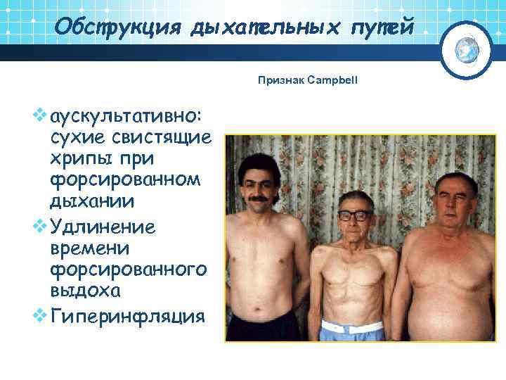 Обструкция дыхательных путей Признак Campbell v аускультативно: сухие свистящие хрипы при форсированном дыхании v