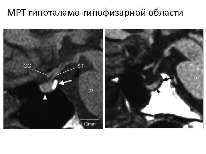 МРТ гипоталамо-гипофизарной области 