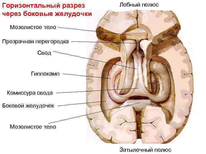 Горизонтальный разрез через боковые желудочки Лобный полюс Мозолистое тело Прозрачная перегородка Свод Гиппокамп Комиссура
