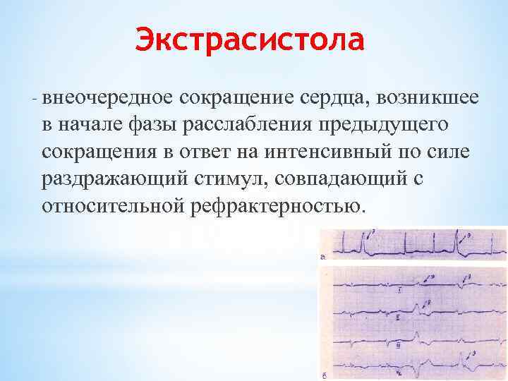 Экстрасистола 5. Внеочередное сокращение сердца. Внеочередная экстрасистолия. Экстрасистола. Экстрасистола физиология.