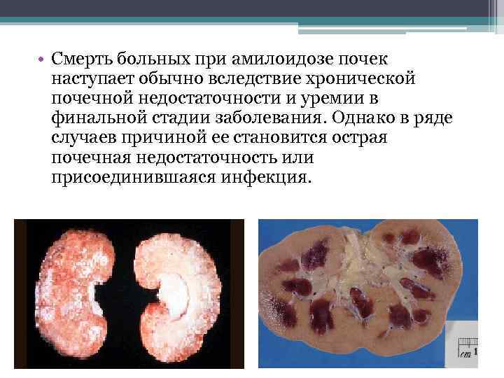  • Смерть больных при амилоидозе почек наступает обычно вследствие хронической почечной недостаточности и