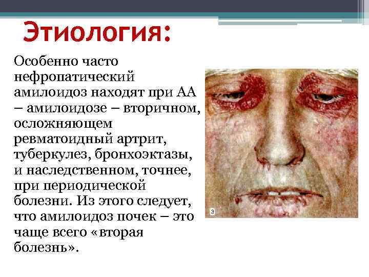 Этиология: Особенно часто нефропатический амилоидоз находят при АА – амилоидозе – вторичном, осложняющем ревматоидный