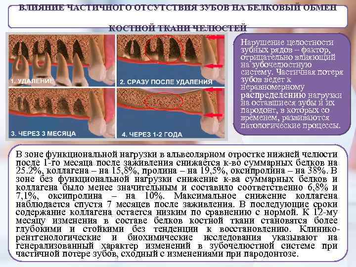 ВЛИЯНИЕ ЧАСТИЧНОГО ОТСУТСТВИЯ ЗУБОВ НА БЕЛКОВЫЙ ОБМЕН КОСТНОЙ ТКАНИ ЧЕЛЮСТЕЙ Нарушение целостности зубных рядов