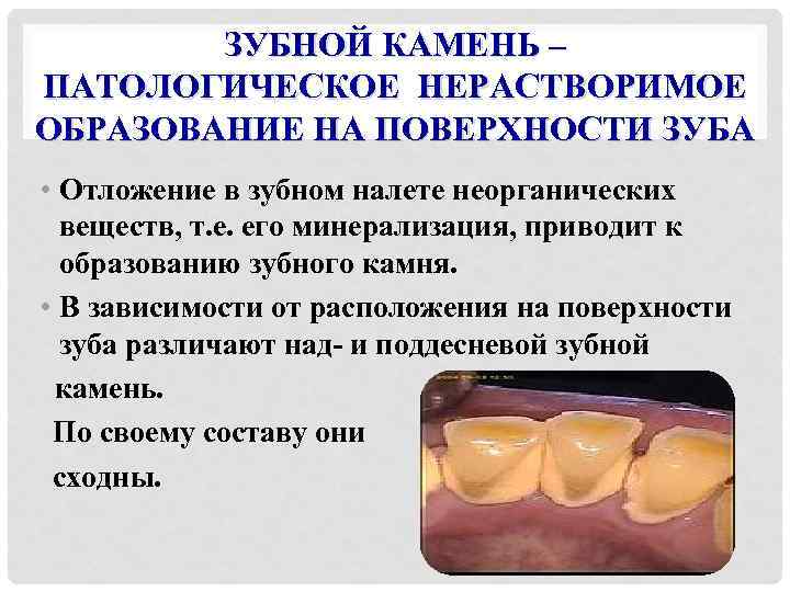 ЗУБНОЙ КАМЕНЬ – ПАТОЛОГИЧЕСКОЕ НЕРАСТВОРИМОЕ ОБРАЗОВАНИЕ НА ПОВЕРХНОСТИ ЗУБА • Отложение в зубном налете