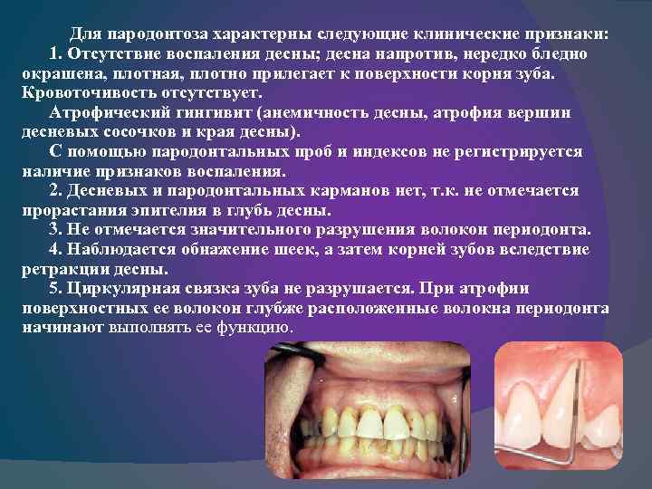 Для пародонтоза характерны следующие клинические признаки: 1. Отсутствие воспаления десны; десна напротив, нередко бледно