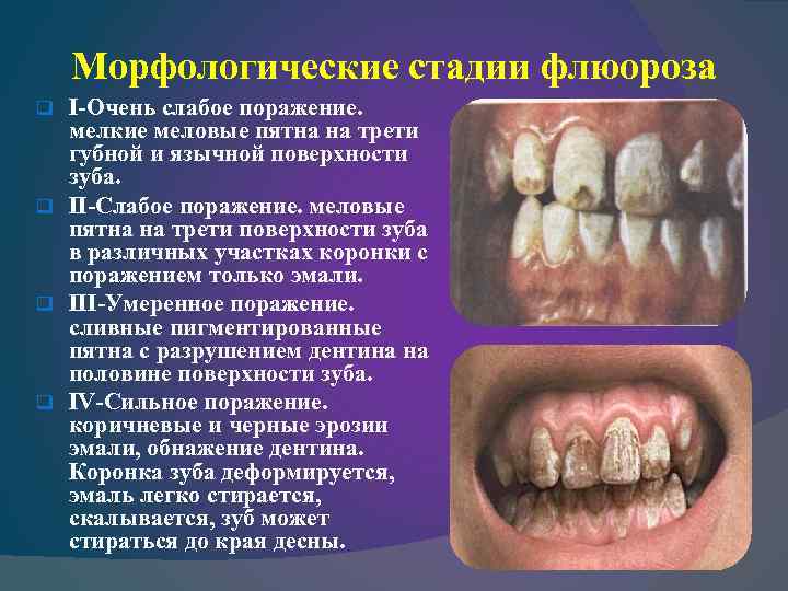 Морфологические стадии флюороза I-Очень слабое поражение. мелкие меловые пятна на трети губной и язычной