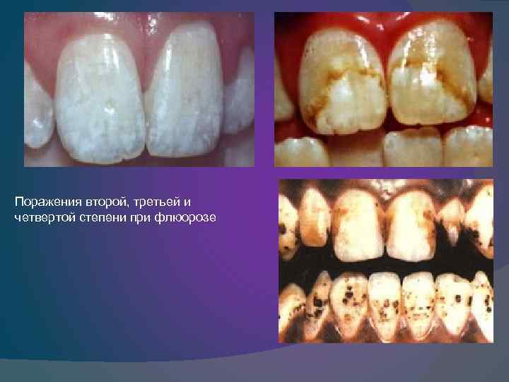 Поражения второй, третьей и четвертой степени при флюорозе 