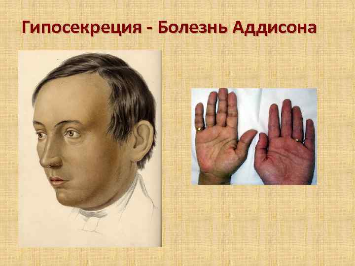 Гипосекреция - Болезнь Аддисона 