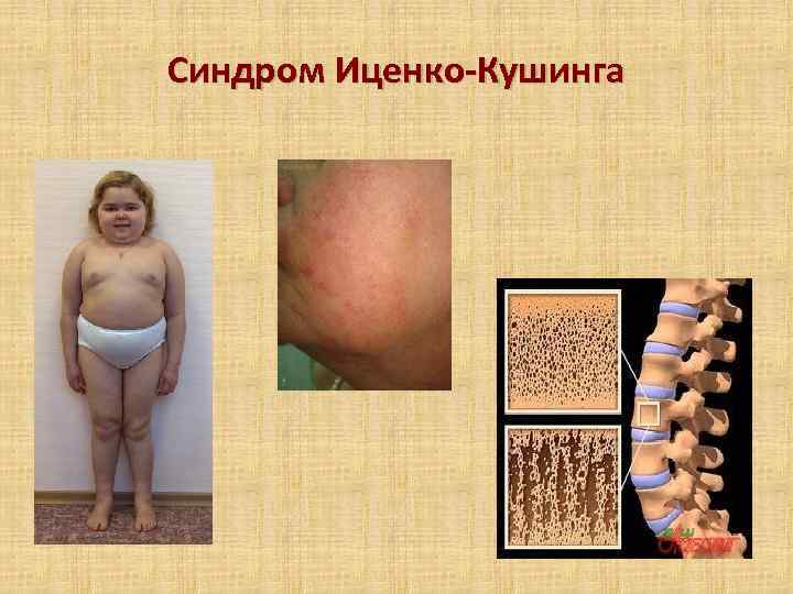 Синдром Иценко-Кушинга 