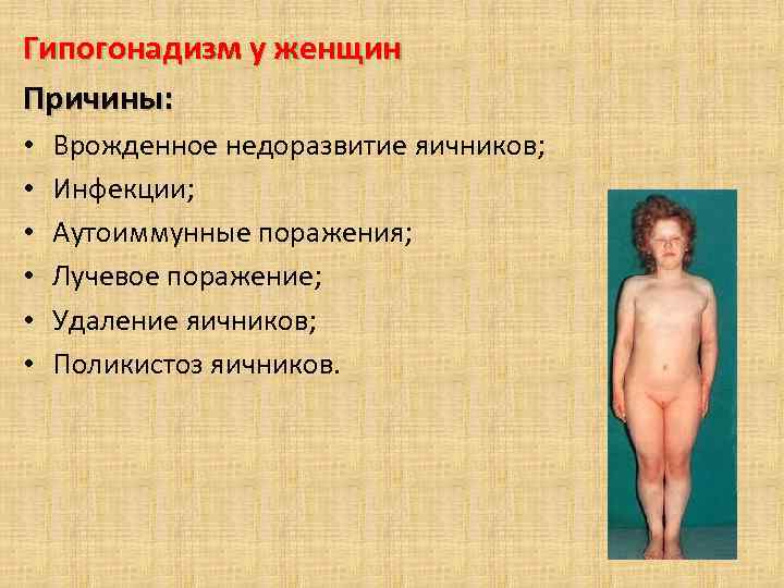 Гипогонадизм у женщин Причины: • • • Врожденное недоразвитие яичников; Инфекции; Аутоиммунные поражения; Лучевое