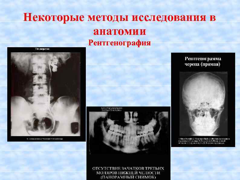 Некоторые методы исследования в анатомии Рентгенография 