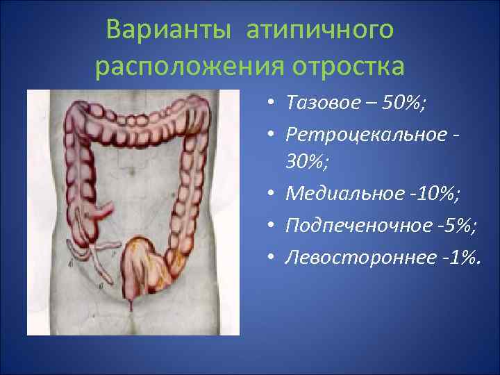 Варианты атипичного расположения отростка • Тазовое – 50%; • Ретроцекальное 30%; • Медиальное -10%;