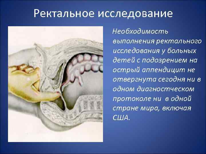 Ректальное исследование Необходимость выполнения ректального исследования у больных детей с подозрением на острый аппендицит