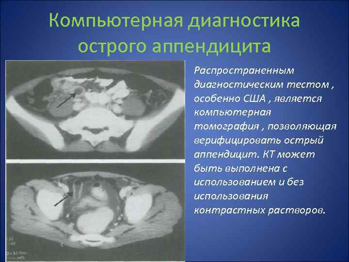 Компьютерная диагностика острого аппендицита Распространенным диагностическим тестом , особенно США , является компьютерная томография
