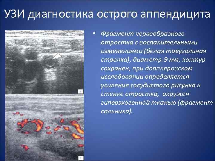 План обследования при аппендиците