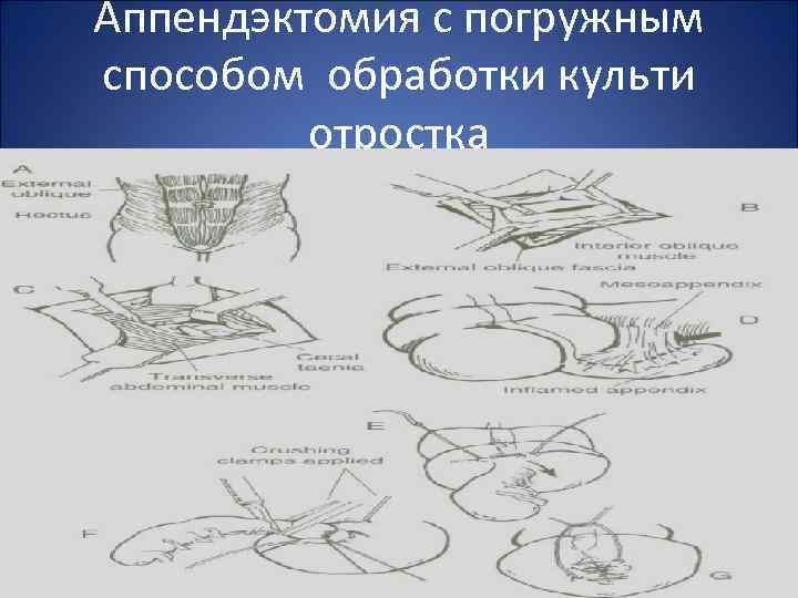 Аппендэктомия с погружным способом обработки культи отростка 