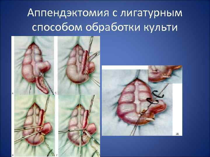 Аппендэктомия с лигатурным способом обработки культи 
