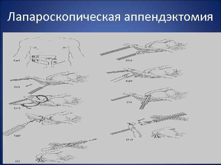 Лапароскопическая аппендэктомия 