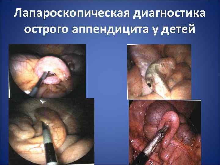 Лапароскопическая диагностика острого аппендицита у детей 
