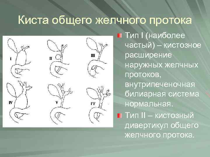 Киста общего желчного протока Тип I (наиболее частый) – кистозное расширение наружных желчных протоков,