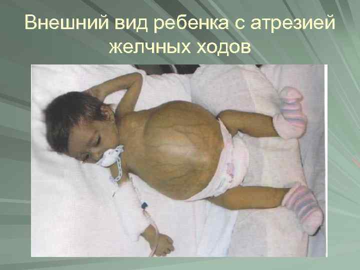 Внешний вид ребенка с атрезией желчных ходов 