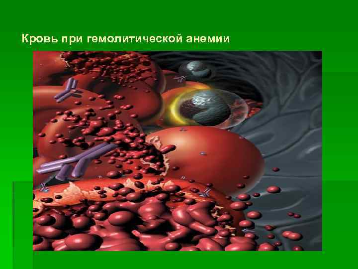 Кровь при гемолитической анемии 