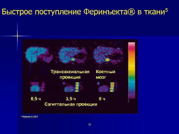 Быстрое поступление Феринъекта® в ткани 5 100 75 L S Трансаксиальная проекция Костный мозг