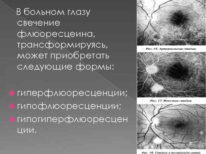 В больном глазу свечение флюоресцеина, трансформируясь, может приобретать следующие формы: гиперфлюоресценции; гипогиперфлюоресцен ции. 