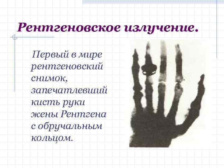 Рентгеновское излучение. Первый в мире рентгеновский снимок, запечатлевший кисть руки жены Рентгена с обручальным