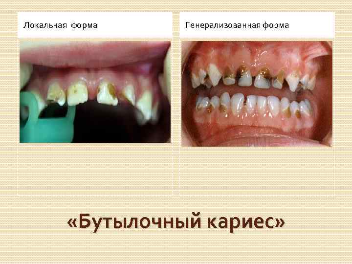 Локальная форма Генерализованная форма «Бутылочный кариес» 