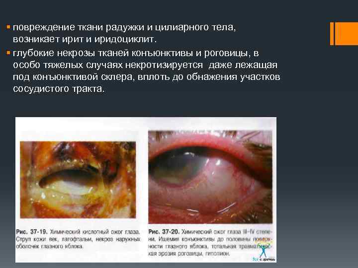 § повреждение ткани радужки и цилиарного тела, возникает ирит и иридоциклит. § глубокие некрозы