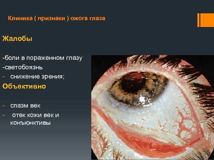 Клиника ( признаки ) ожога глаза Жалобы -боли в пораженном глазу -светобоязнь - снижение