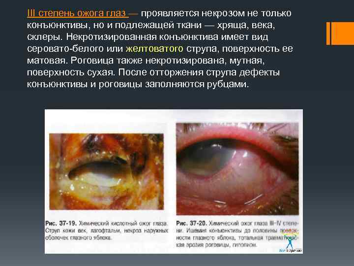 III степень ожога глаз — проявляется некрозом не только конъюнктивы, но и подлежащей ткани