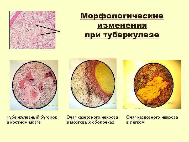 Морфологические изменения при туберкулезе Туберкулезный бугорок в костном мозге Очаг казеозного некроза в мозговых